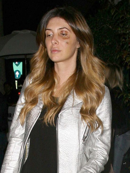 Przyjaciółka Kim Kardashian chodzi z limo pod okiem (FOTO)