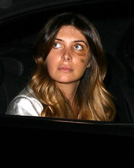 Przyjaciółka Kim Kardashian chodzi z limo pod okiem (FOTO)