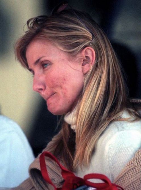 Te gwiazdy borykają się z trądzikiem (FOTO)