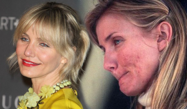 Te gwiazdy borykają się z trądzikiem (FOTO)