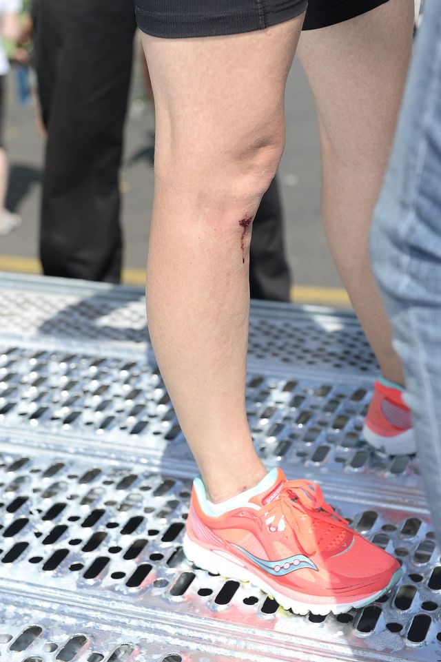 Spalona skóra i rozbite kolano Kasi Glinki (FOTO)