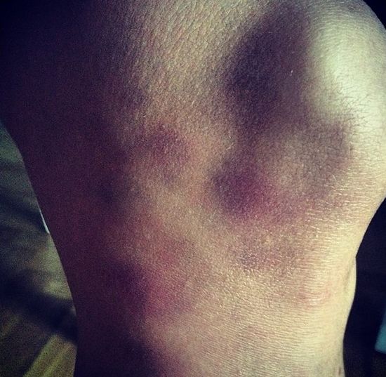 Joanna Jabłczyńska cała w siniakach! (FOTO)