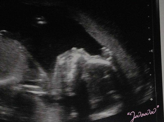 Jej nienarodzone dziecko ma torbiel na mózgu, a ona...