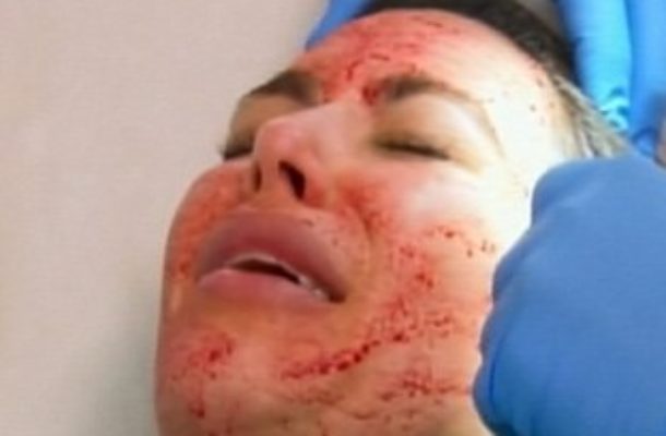 Kim Kardashian: Wampirzy lifting na wizji (FOTO)