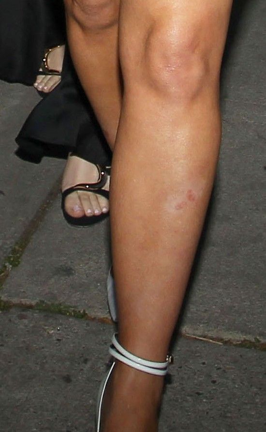 Jak Kim Kardashian radzi sobie z łuszczycą?