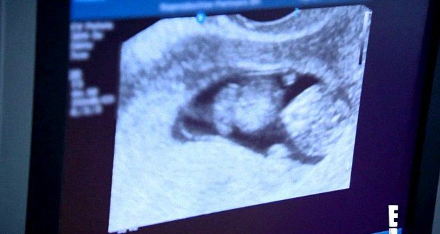 Kim Kardashian może mieć poważne problemy ze zdrowiem!