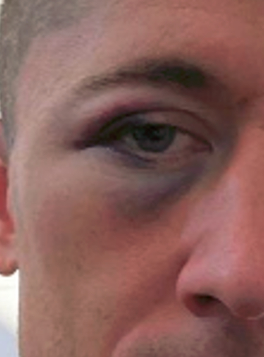 Lewandowski ma PODBITE oko! Co się stało? Lewandowski ma PODBITE oko! Co się stało?