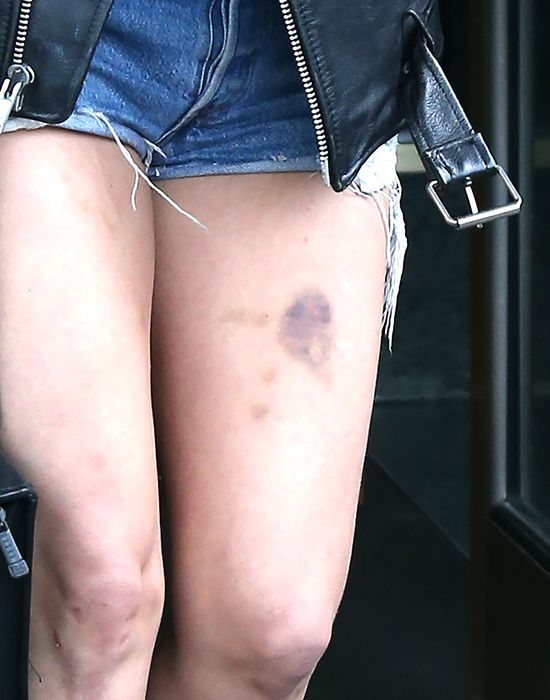 OMG! Co stało się z jej nogami? (FOTO)