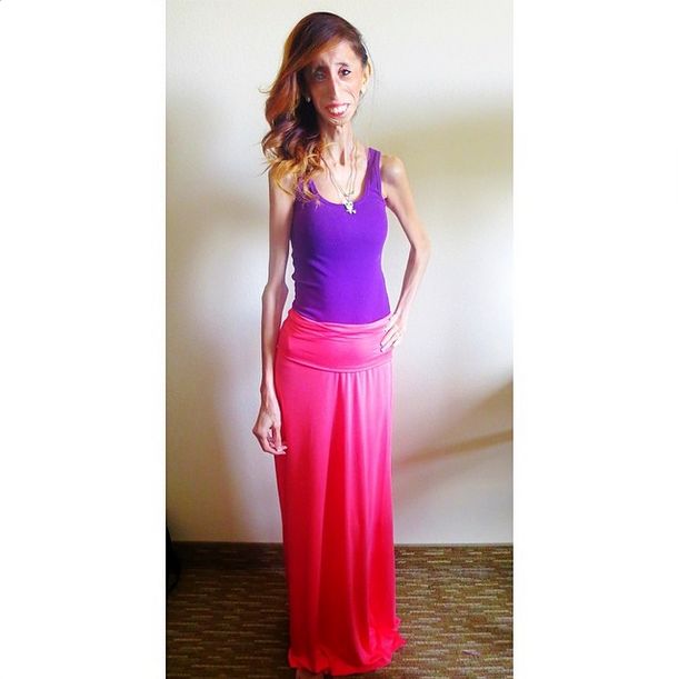 Lizzie Velasquez zwana najbrzudszką kobietą świata... (FOTO)