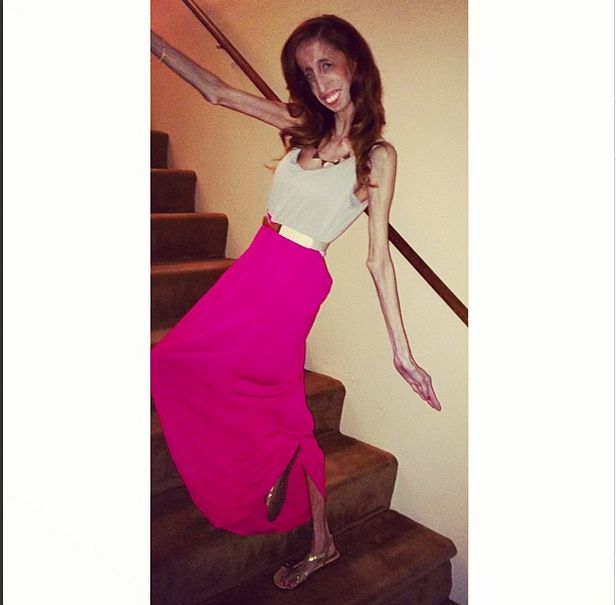 Lizzie Velasquez zwana najbrzudszką kobietą świata... (FOTO)