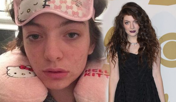 Te gwiazdy borykają się z trądzikiem (FOTO)