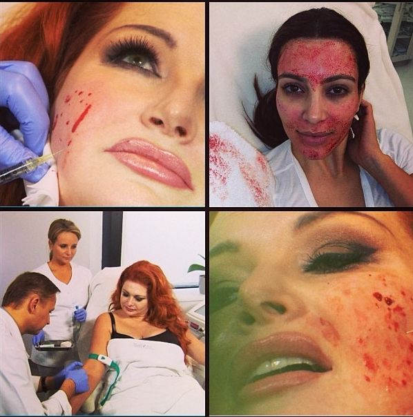 Marta Grycan zrobiła sobie wampirzy lifting (FOTO)