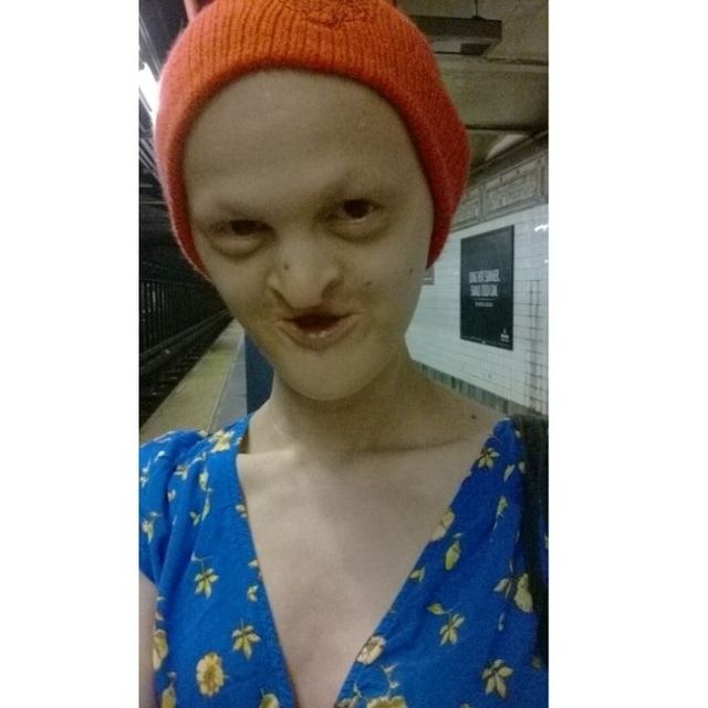 Melanie Gaydos - modelka high fashion z chorobą genetyczną