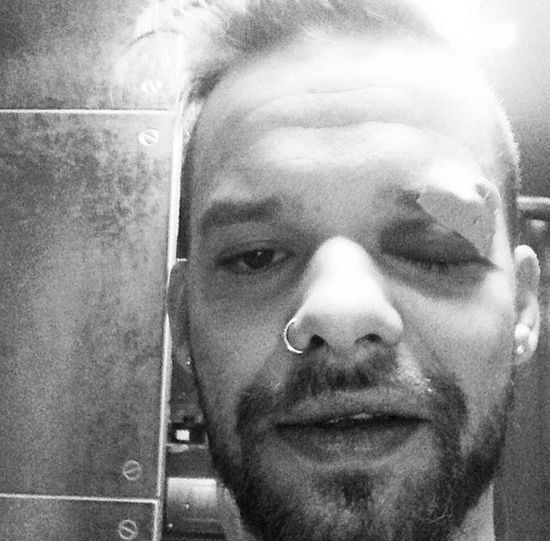 Michał Piróg dostał w... oko (FOTO)