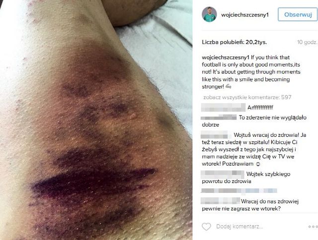 Wojciech Szczęsny pokazał, jak wygląda jego noga! (FOTO) Wojciech Szczęsny pokazał, jak wygląda jego noga! (FOTO)