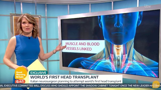 Pierwsza w historii transplantacja CAŁEJ GŁOWY jest możliwa?! (VIDEO) Pierwsza w historii transplantacja CAŁEJ GŁOWY jest możliwa?! (VIDEO)