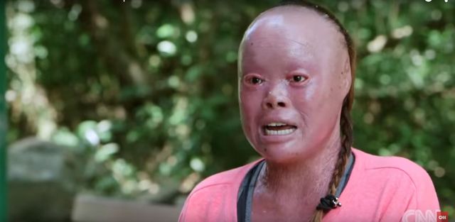 Rodzice porzucili ją, bo przestraszyli się jej wyglądu VIDEO Rodzice porzucili ją, bo przestraszyli się jej wyglądu VIDEO