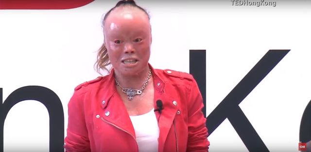 Rodzice porzucili ją, bo przestraszyli się jej wyglądu VIDEO Rodzice porzucili ją, bo przestraszyli się jej wyglądu VIDEO