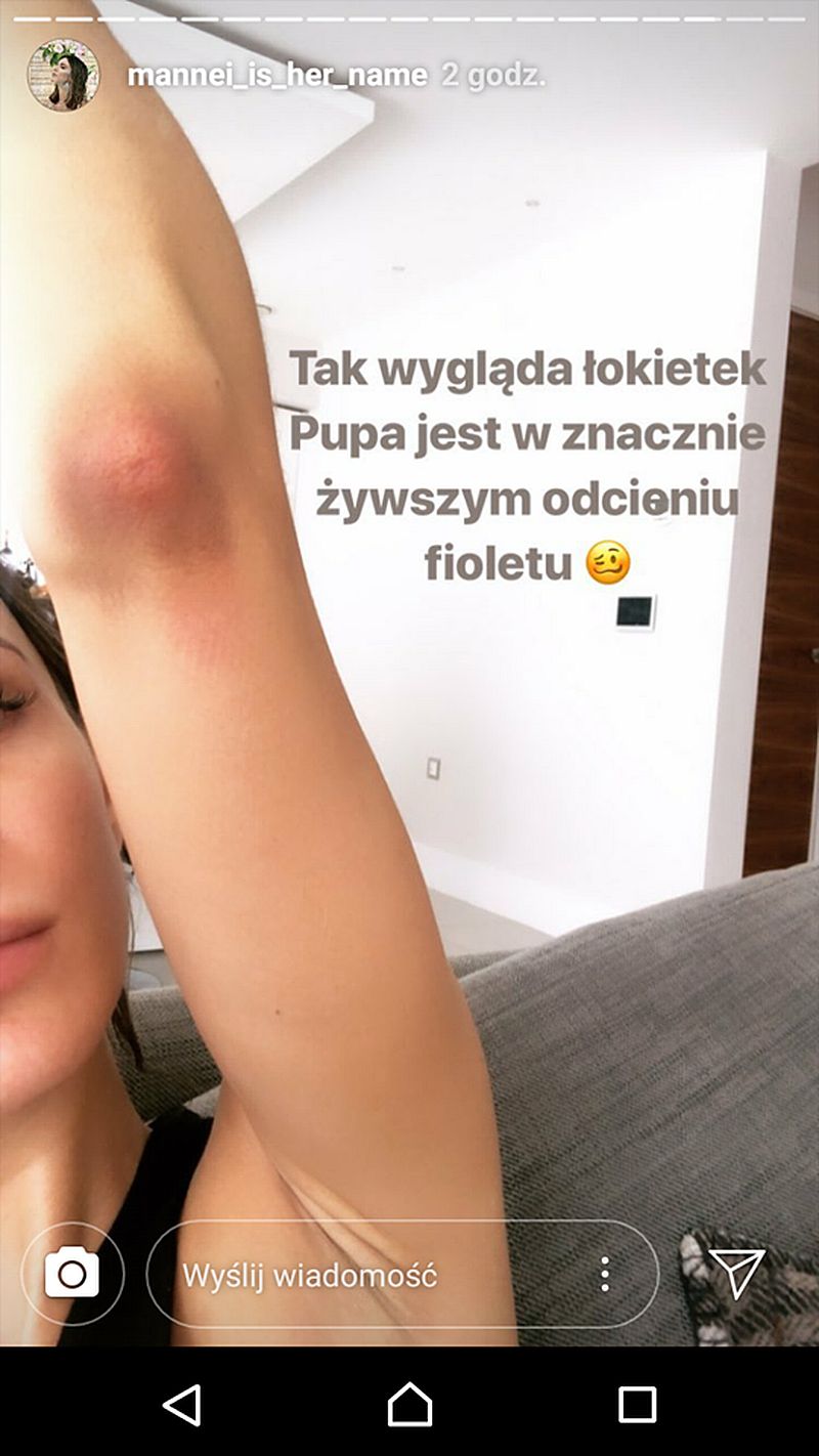 Sara Boruc pokazuje siniaki po upadku