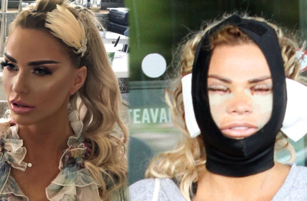 Katie Price i jej kolejna operacja plastyczna. Wygląda przerażająco – UWAGA! Drastyczne (FOTO)