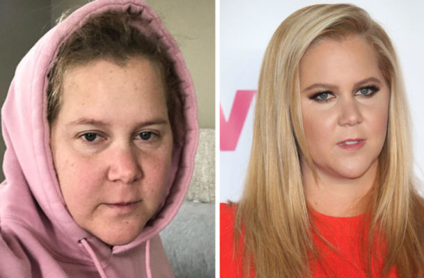 Amy Schumer nie może znieść procesu IN VITRO. Pokazała swój PORANIONY brzuch