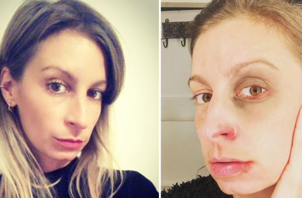 Magdalena Schejbal z PODBITYM okiem apeluje: „Pod makijażem, kobiety ukrywają swój ból”