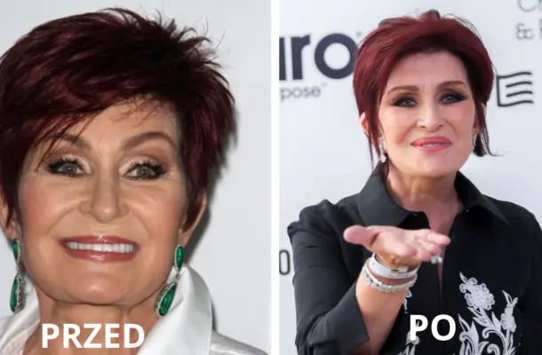 Załamana Sharon Osbourne: „koszmarny lifting sprawił, że wyglądam jak cyklop”