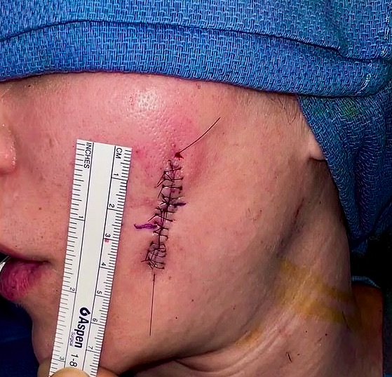 Khloe Kardashian czerniak