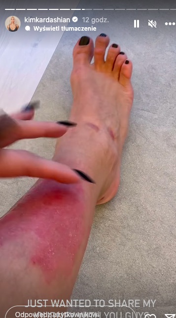 Kim Kardashian łuszczyca