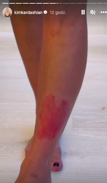 Kim Kardashian łuszczyca