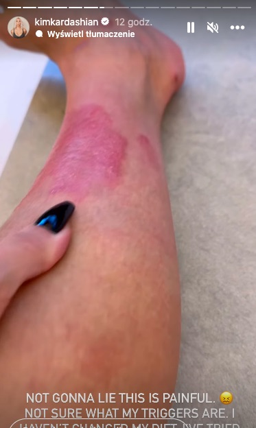 Kim Kardashian łuszczyca