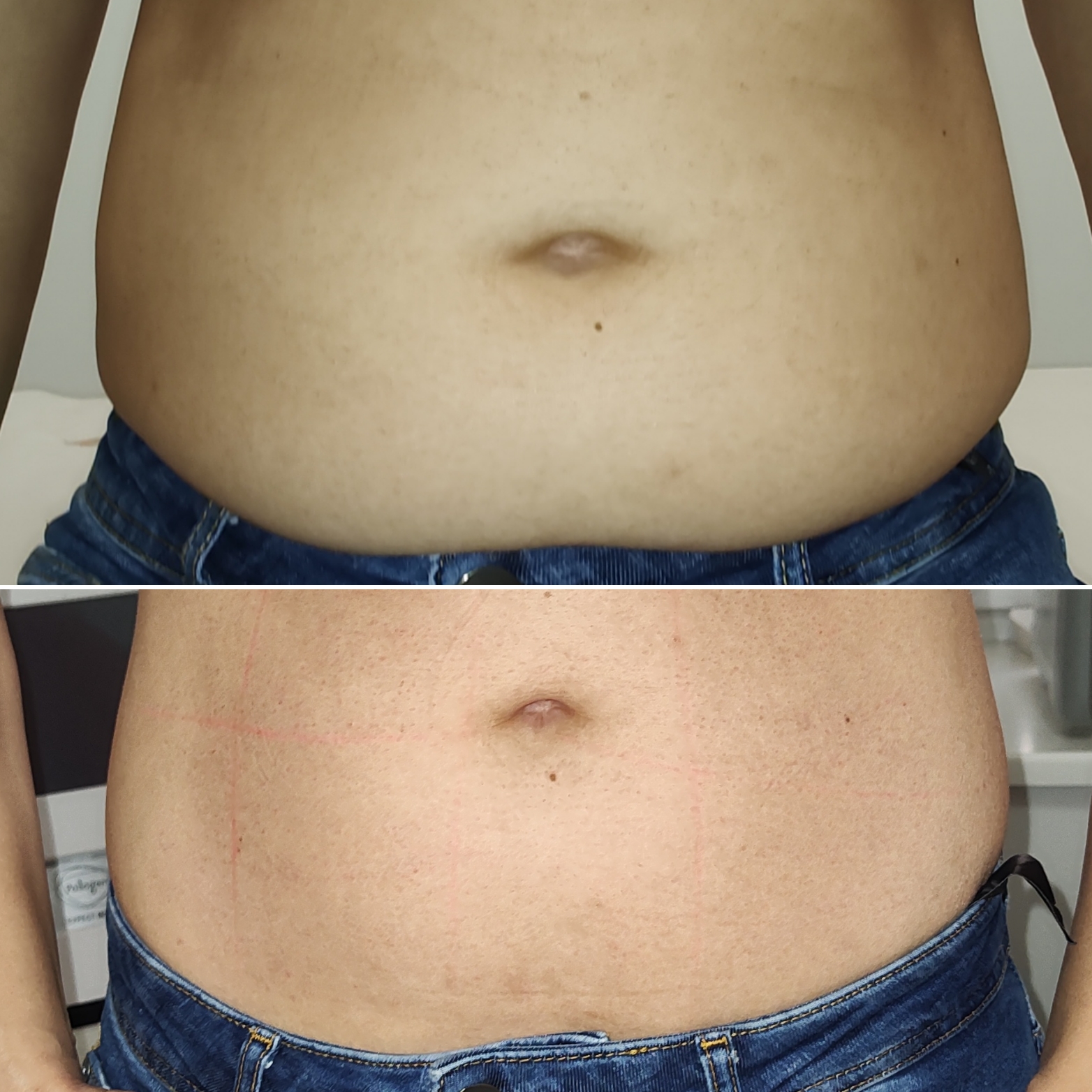 HIFU – najskuteczniejszy zabieg PREMIUM do modelowania twarzy i ciała. Sprawdź sama!