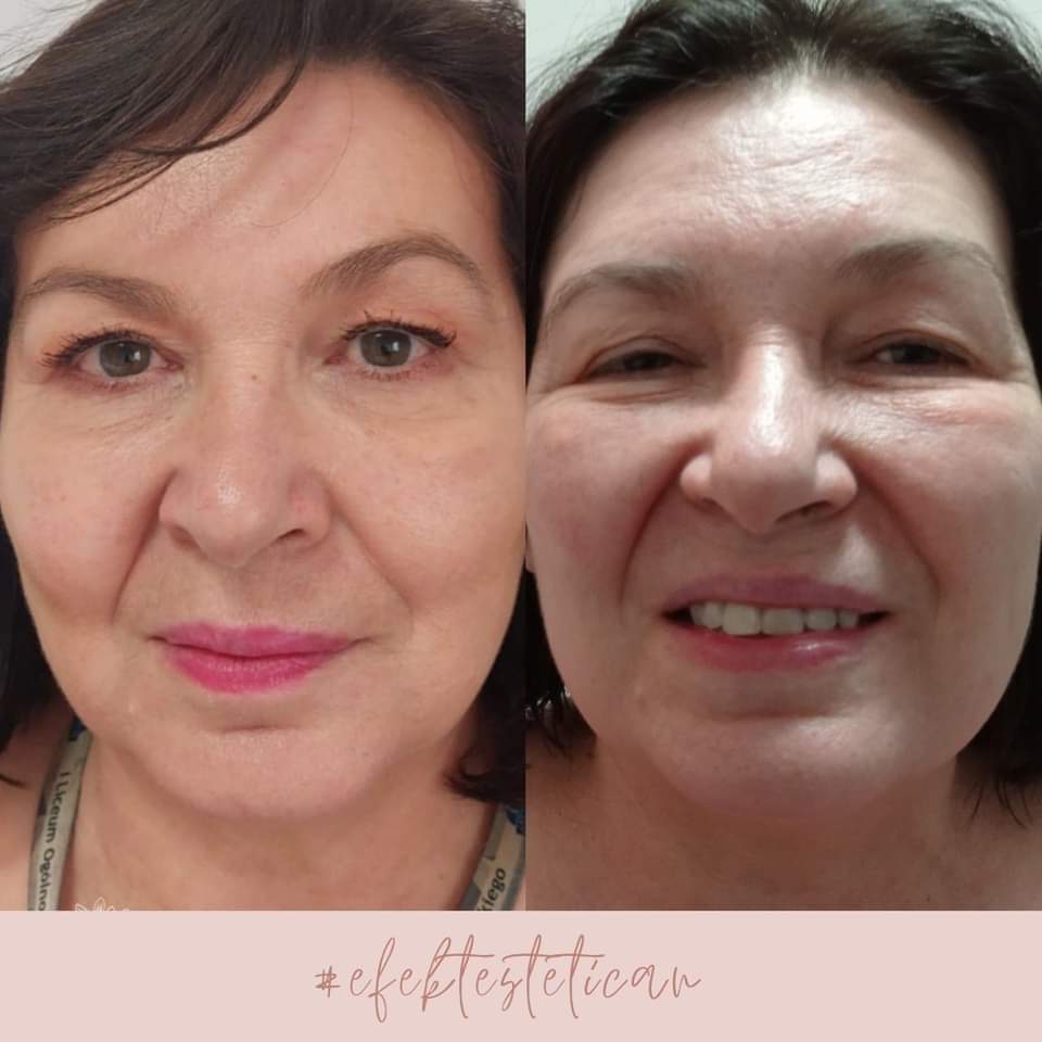 HIFU – najskuteczniejszy zabieg PREMIUM do modelowania twarzy i ciała. Sprawdź sama!