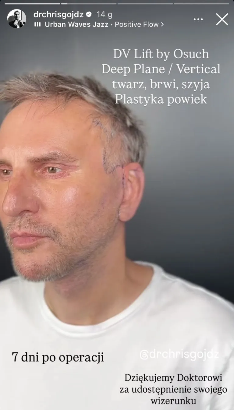 krzysztof-gojd-zrobi-sobie-lifting-twarzy-tak-wygl-da-po-tygodniu