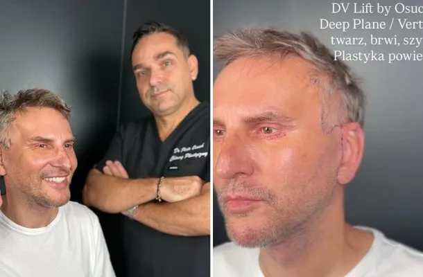 Krzysztof Gojdź pokazał efekty głębokiego liftingu. Tak wygląda tydzień po operacji! ZDJĘCIA