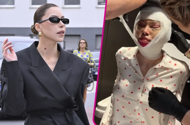 Julia Von Stein ujawnia kolejne kulisy liftingu: „Nie było planu, żebym robiła lifting twarzy absolutnie”