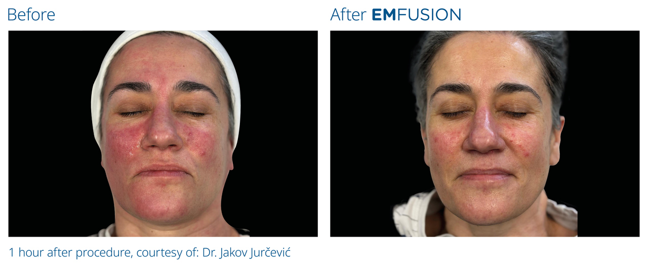 Nowa era pielęgnacji skóry. Technologia BTL, która działa głębiej niż krem