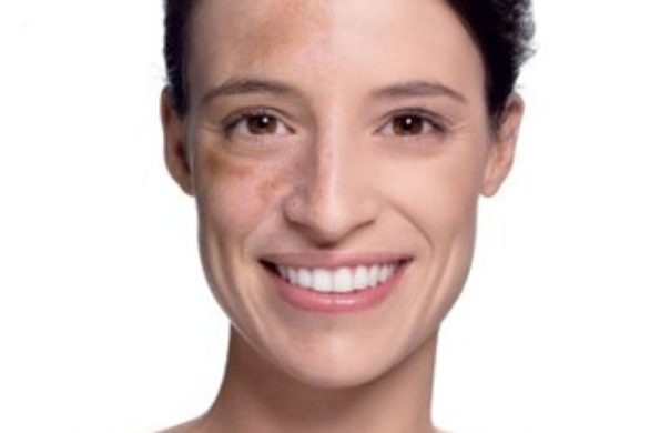 Pytanie o urodę: Jak usunąć przebarwienia na twarzy?