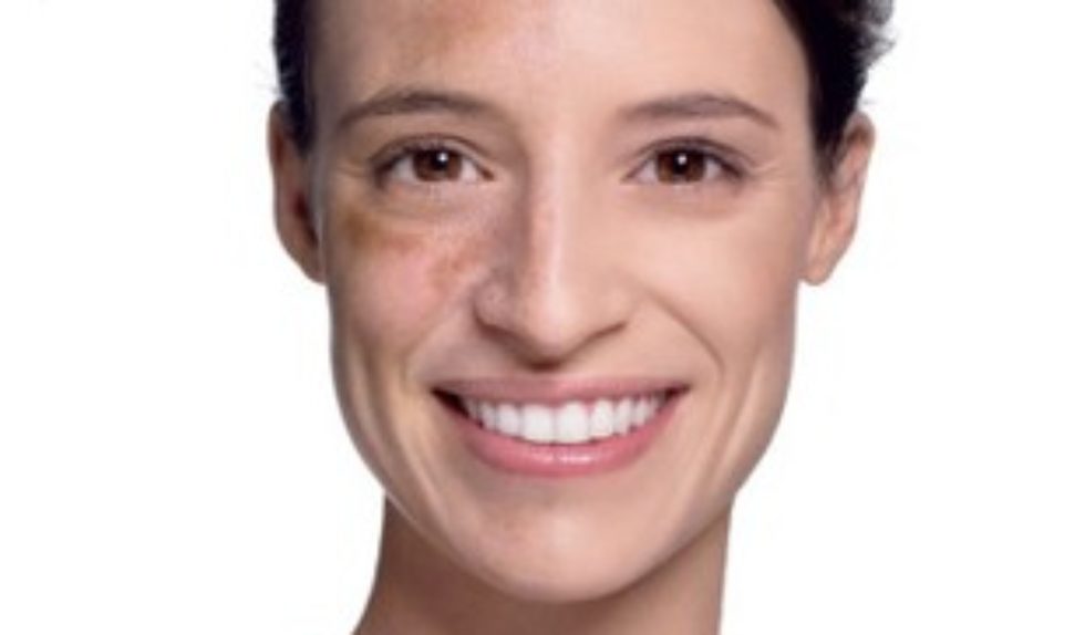 Pytanie o urodę: Jak usunąć przebarwienia na twarzy?