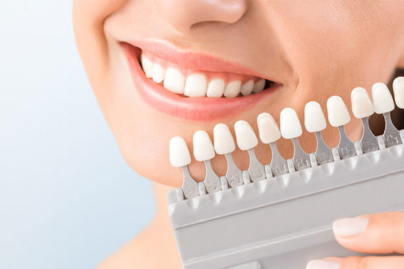 Wybielanie zębów – którą metodę wybrać? Przegląd produktów do użytku domowego