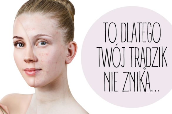 Nierówna walka z trądzikiem – oto powody, przez które nie można się go pozbyć