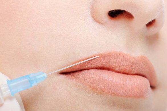 Powiększanie ust kwasem hialuronowym – co powinnyście wiedzieć?