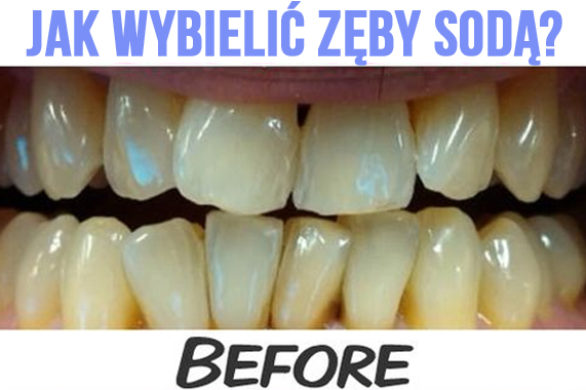 Jak wybielić zęby sodą?