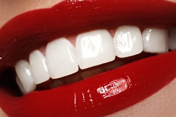 Wszystko, co powinnaś wiedzieć o wybielaniu zębów. Co? Gdzie? I jak?