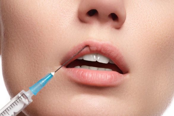 6 pytań dotyczących powiększania ust – co powinnaś wiedzieć? (FOTO)