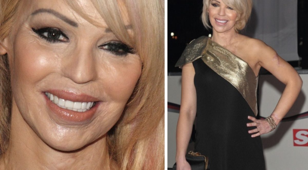 Poparzona kwasem Katie Piper: Ładna buzia nie wystarczy!