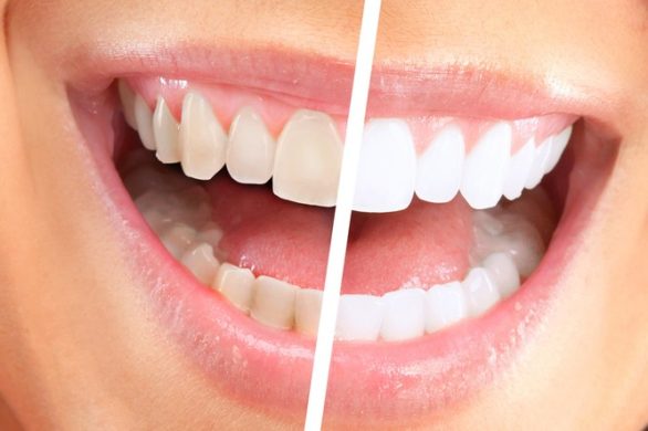 Czy pasty wybielające działają?