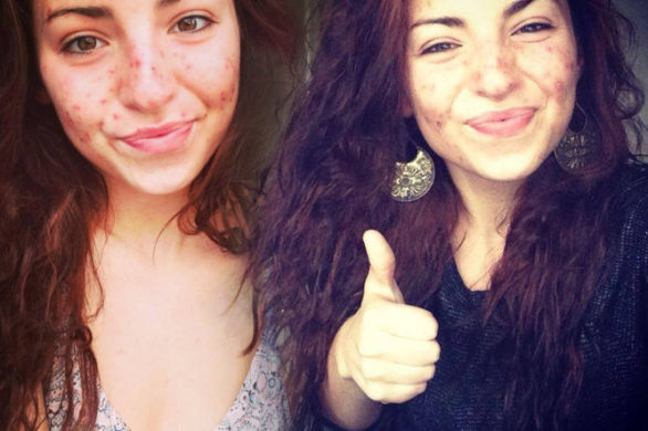 Poznajcie Samanthę Wake, 20-latkę rozdrapującą twarz do krwi