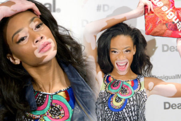 Winnie Harlow, modelka z bielactwem, została twarzą Desigual
