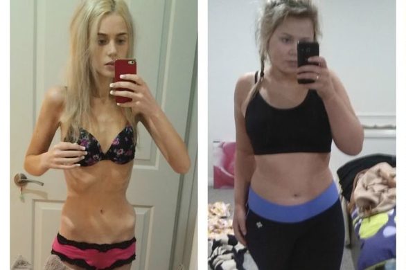 Historia tej anorektyczki bije rekordy popularności (VIDEO)